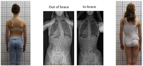 Needing a brace after scoliosis surgery